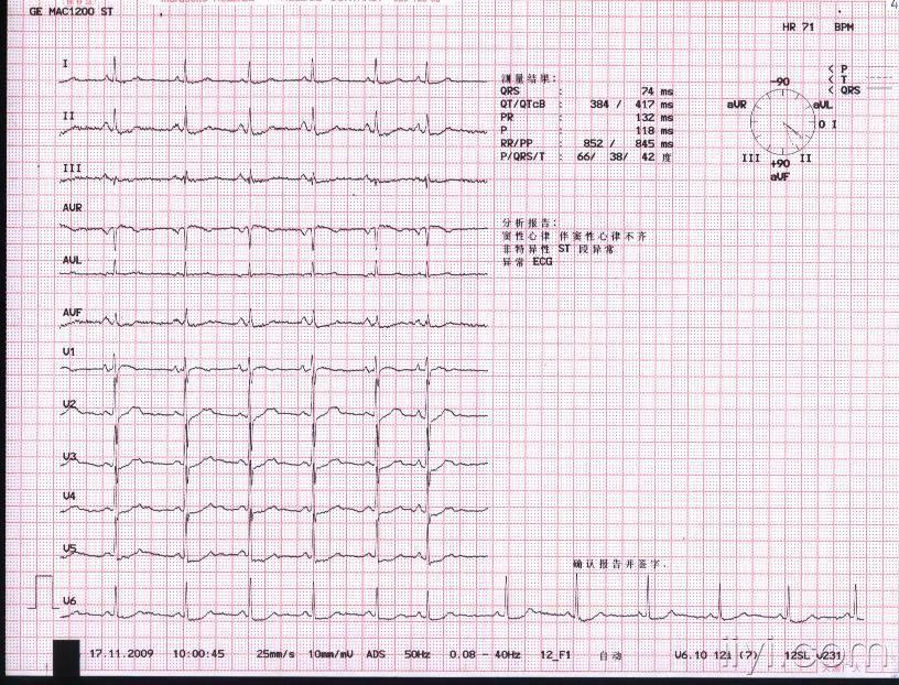 091117----心电图.jpg
