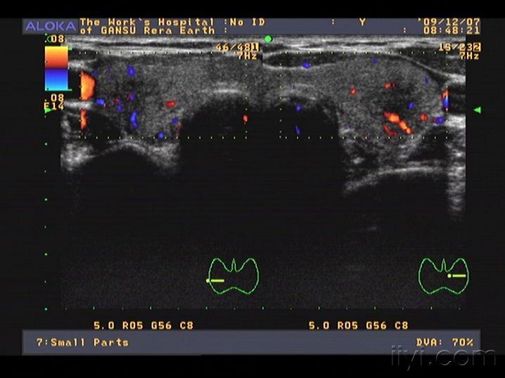 甲亢伴亚急性甲状腺炎 - 超声医学讨论版 - 爱爱医