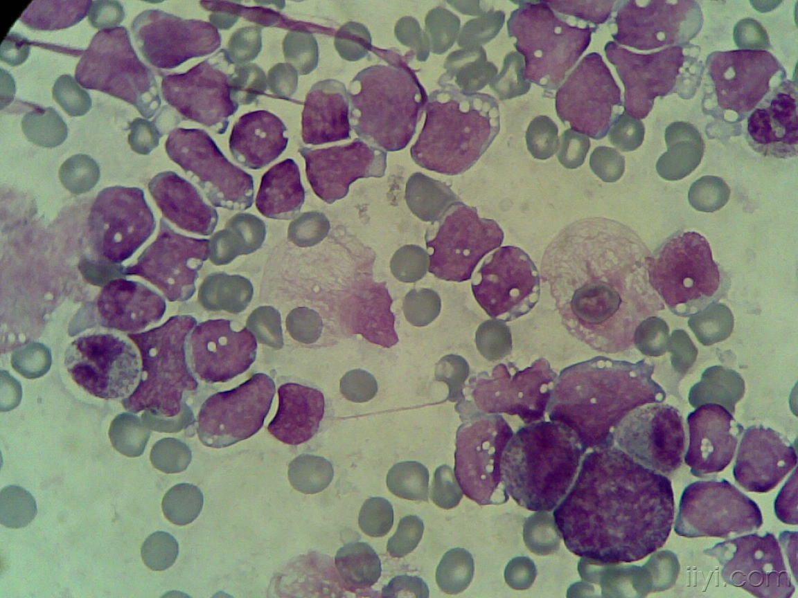 急性淋巴细胞白血病l3图谱