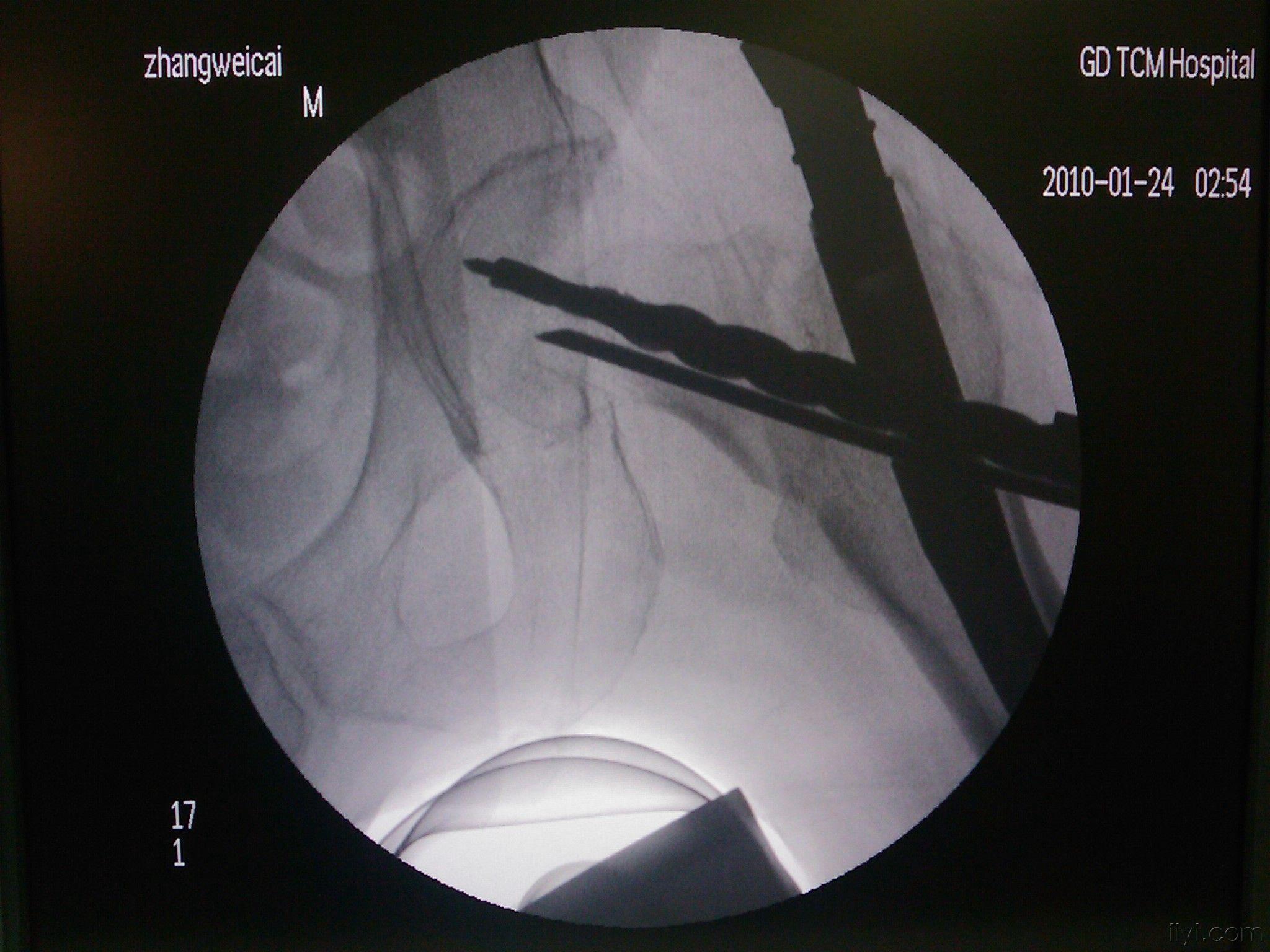 病例分享,髋部骨折第四代髓内固定系统intertan