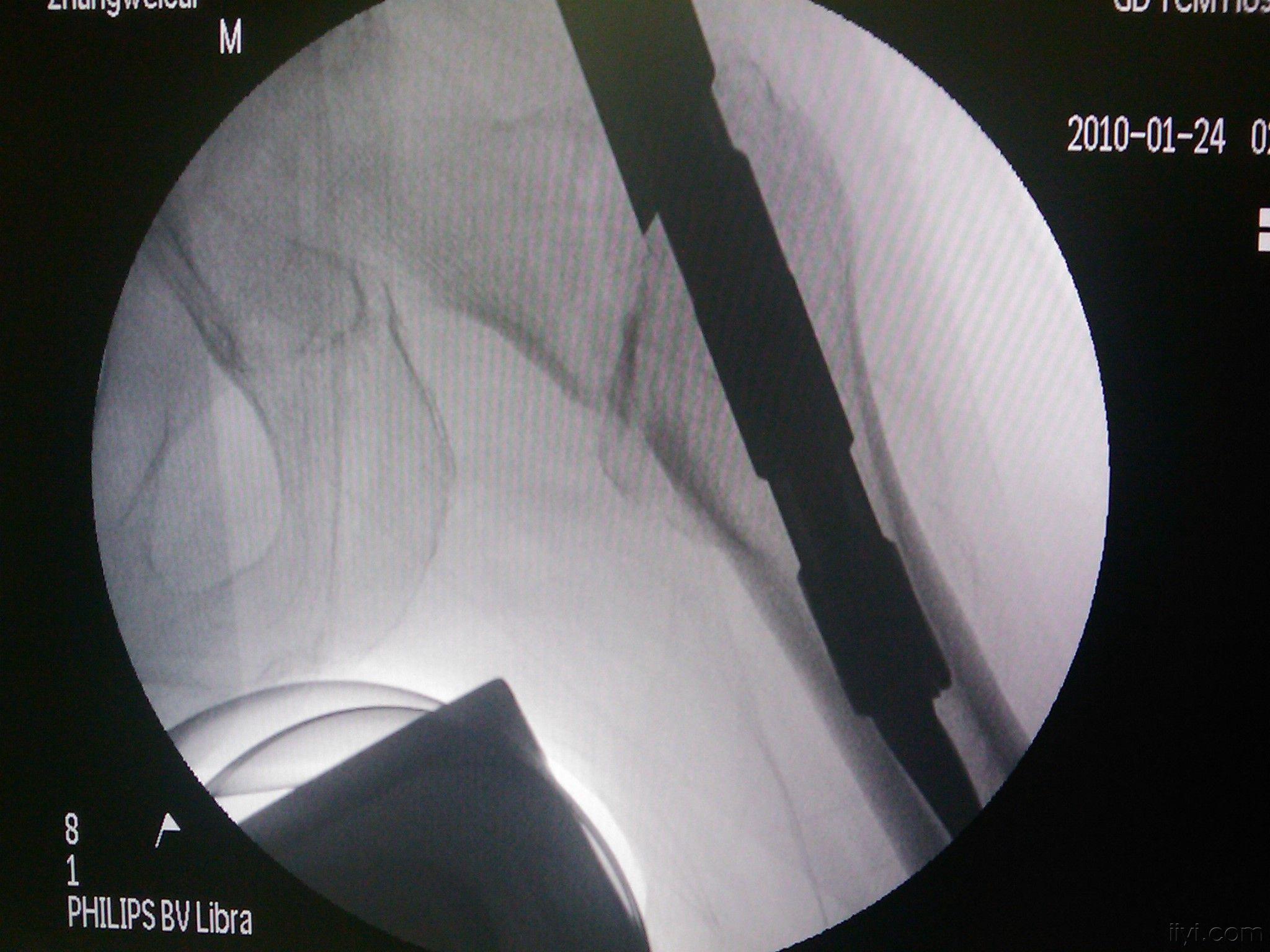 病例分享,髋部骨折第四代髓内固定系统intertan