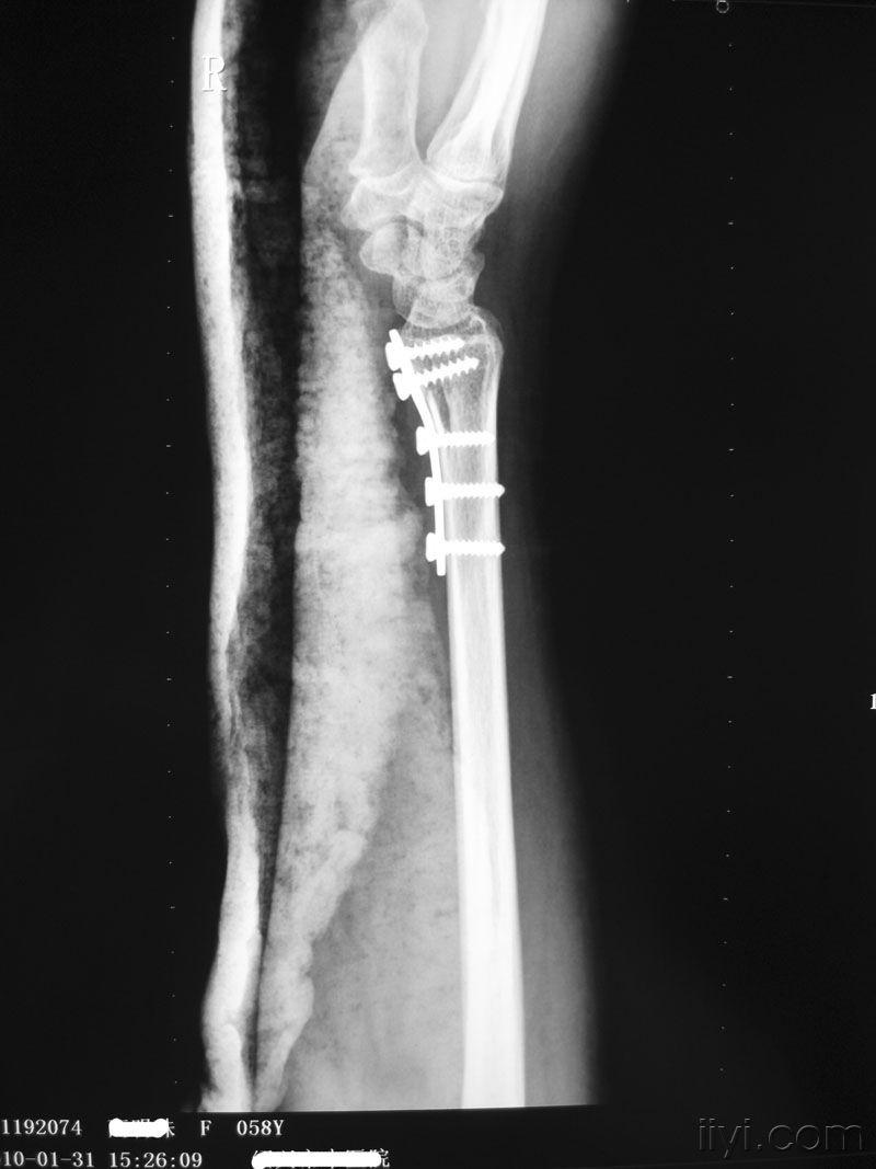 右barton骨折一例