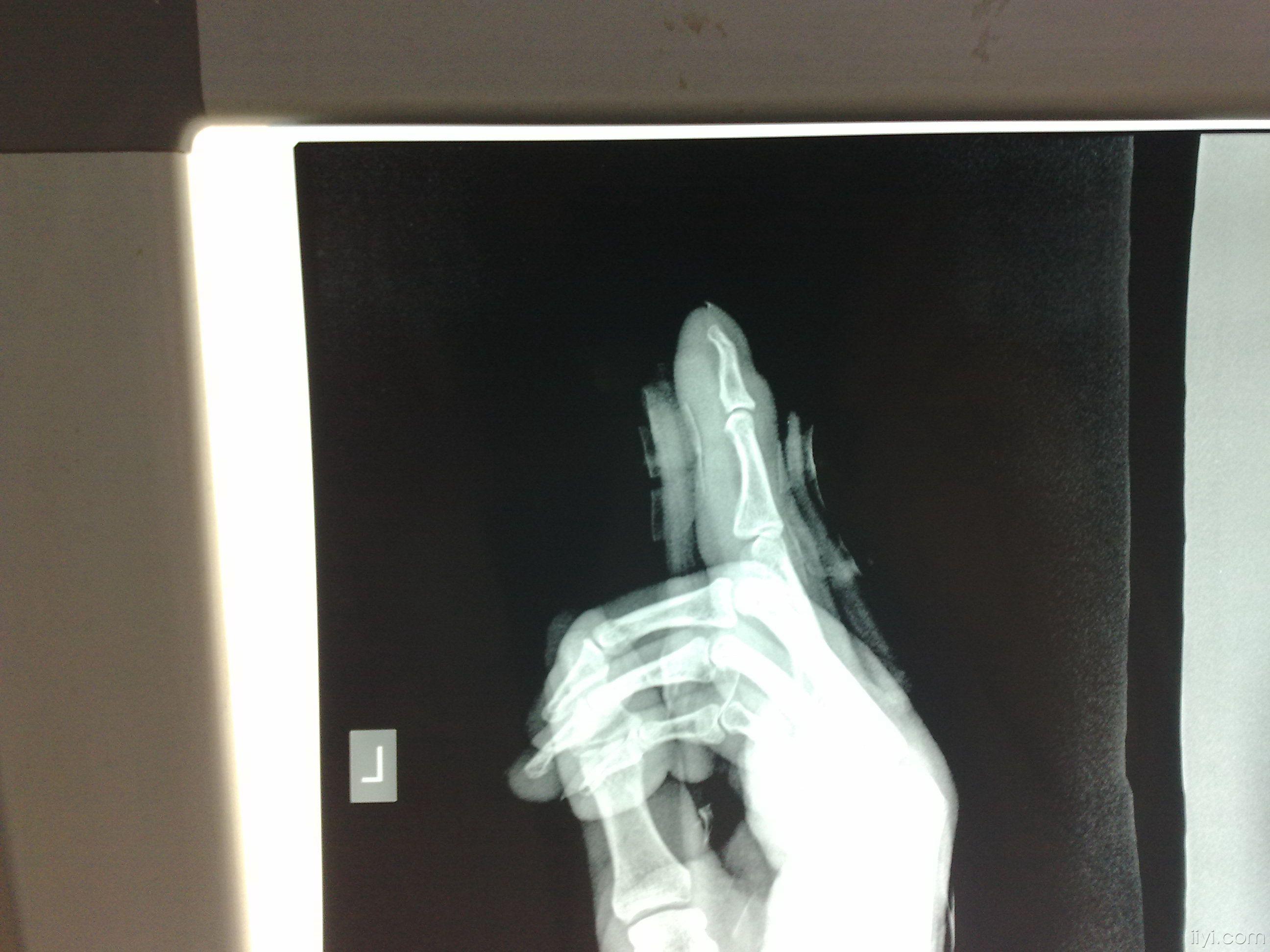 左食指骨折手法复位夹板固定