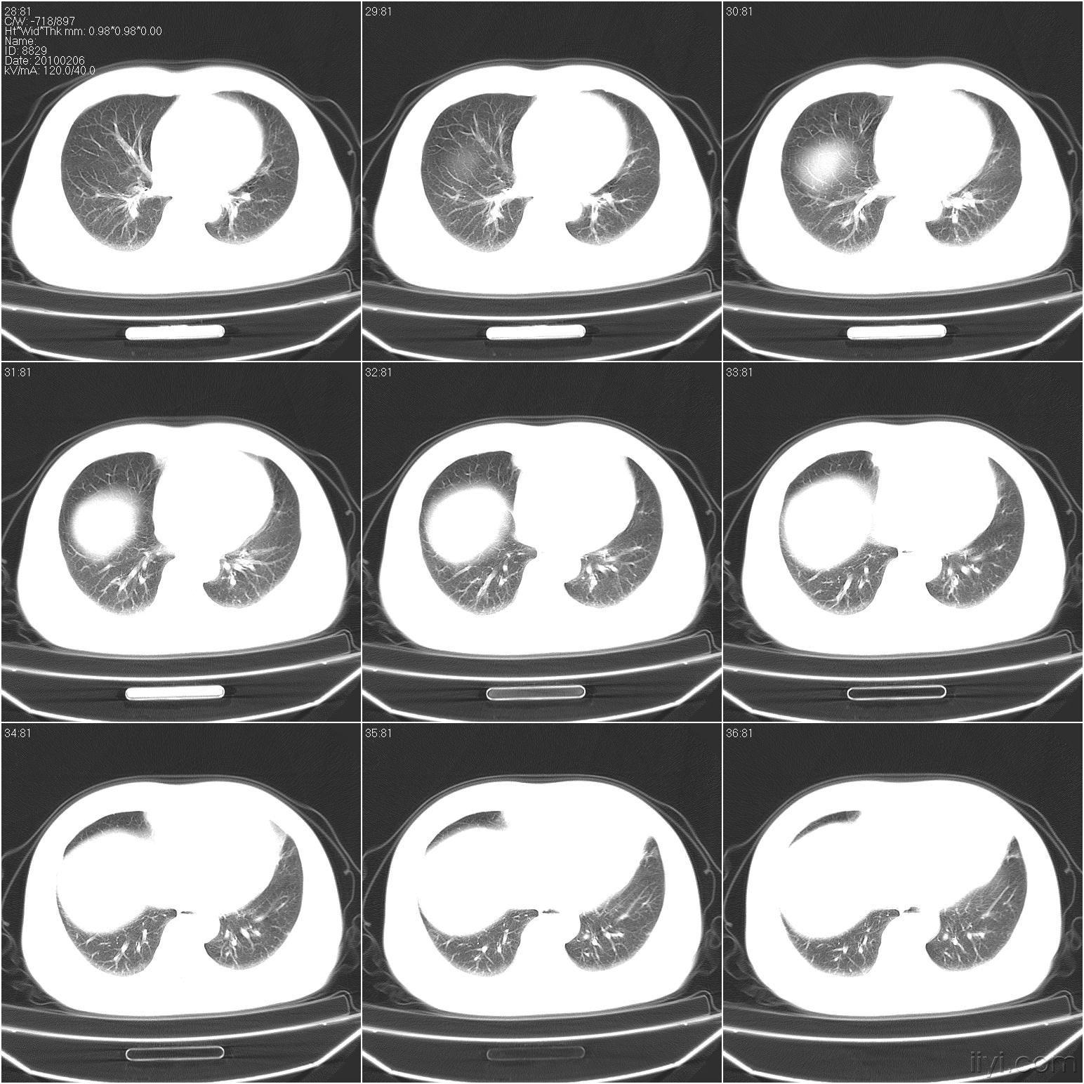 肺部ct,请同行帮忙阅片 医学影像学讨论版 爱爱医医学论坛