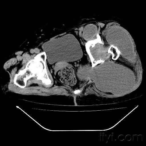 请看一髋关节ct