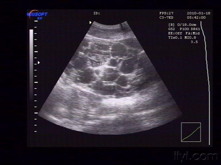 多囊肾(典型,好病例,一起分享 超声医学讨论版 爱爱医