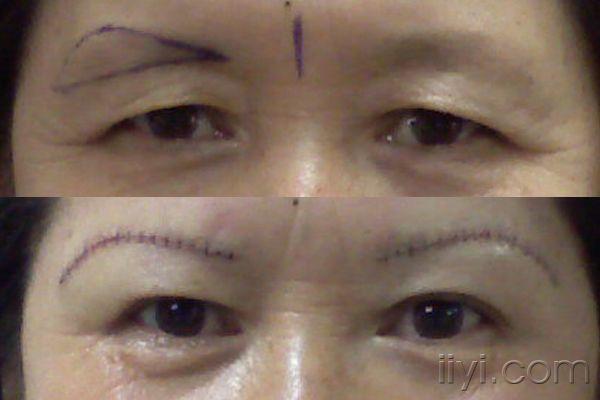 切眉术