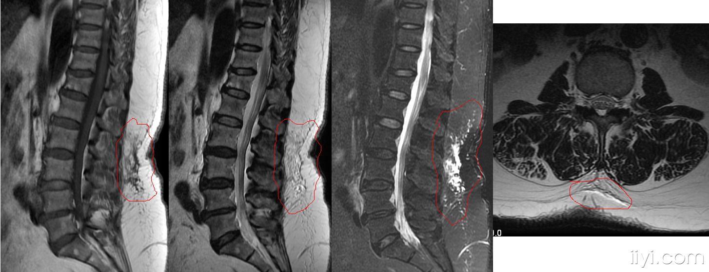 请大家帮忙看一下腰椎mr谢谢