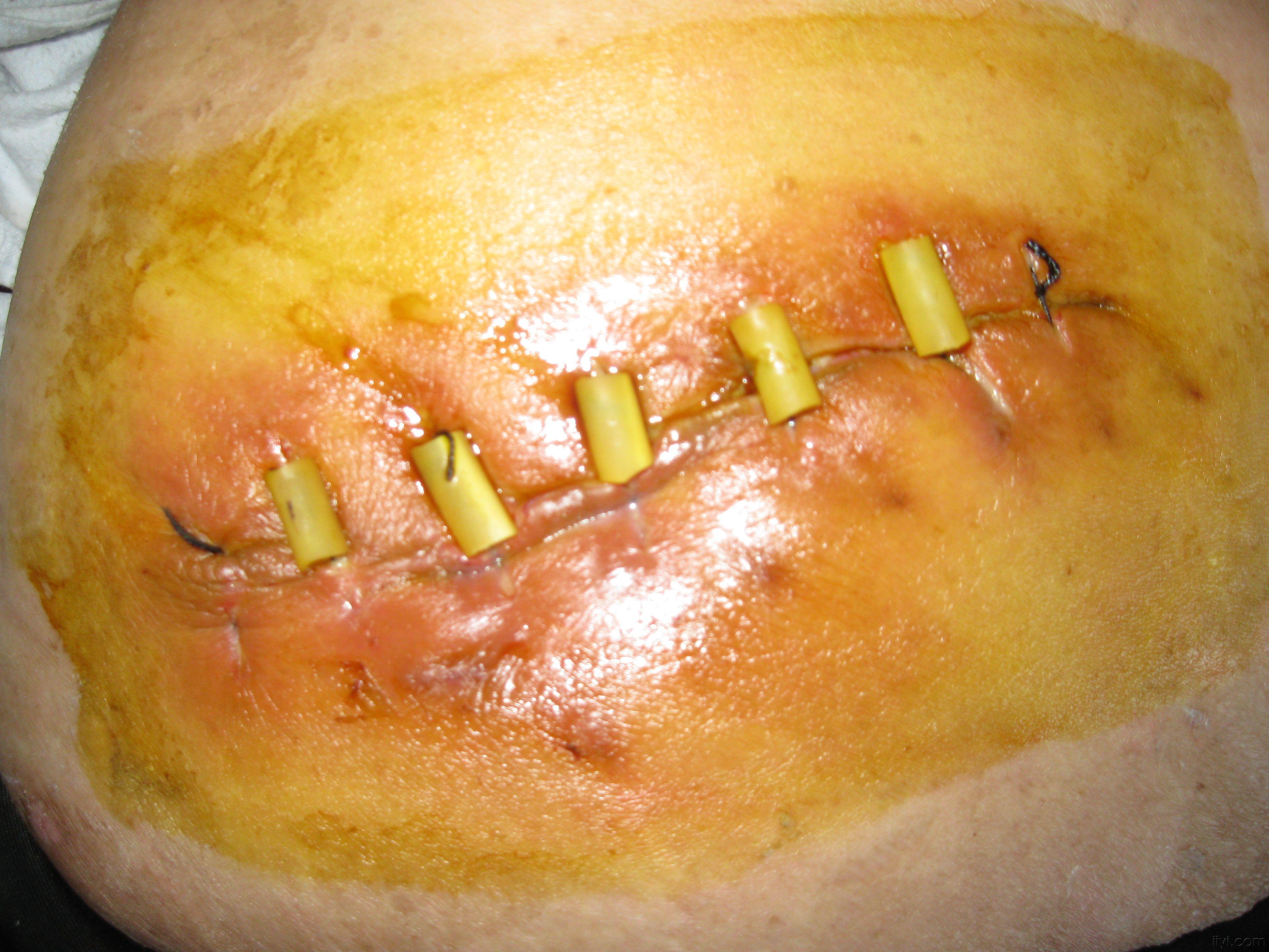 胆囊切除术后切口不愈附图片请高手指教