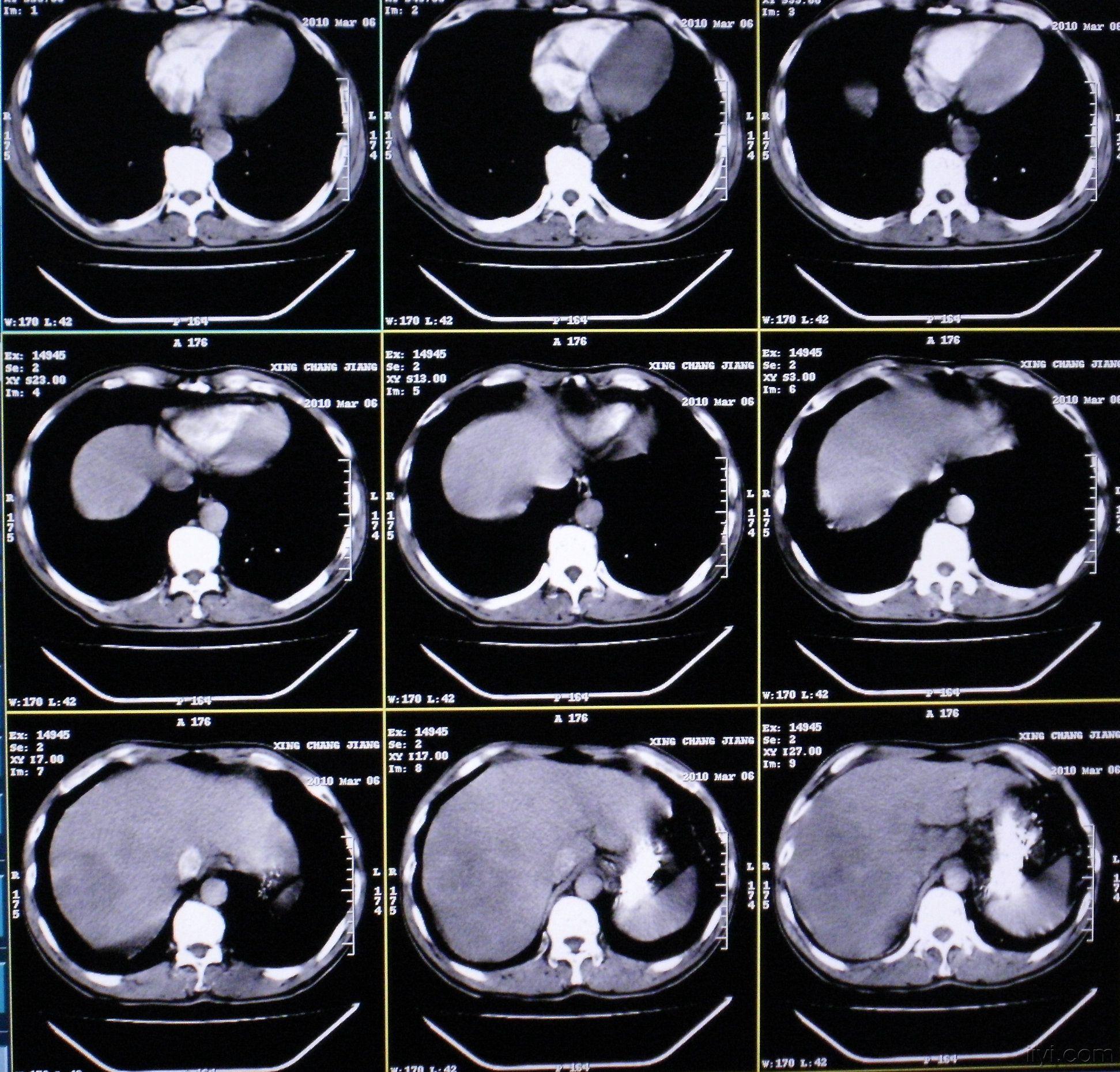 [读片]腹部/ct平扫 增强/病理已公布/20100316