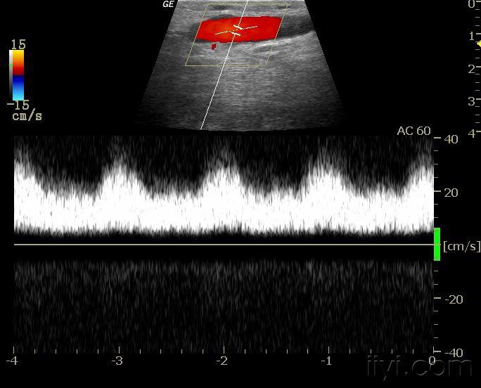 这是浅静脉内的血流频谱,已经是动脉化的静脉频谱了,因为瘘口很大