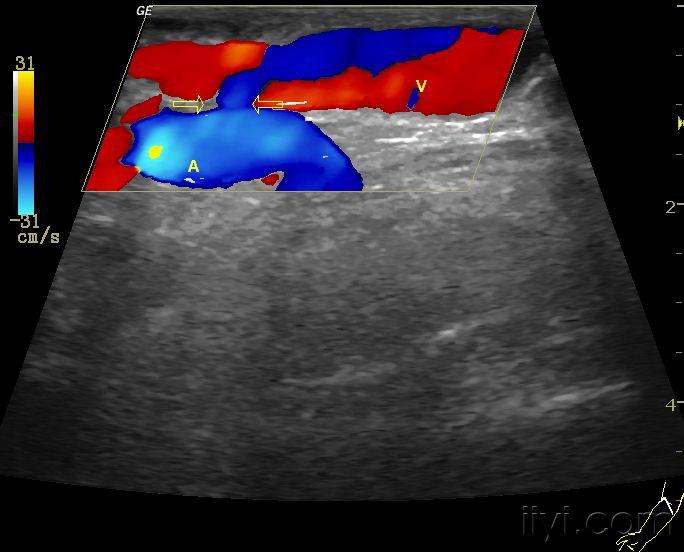 动静脉瘘 超声医学讨论版 爱爱医医学论坛