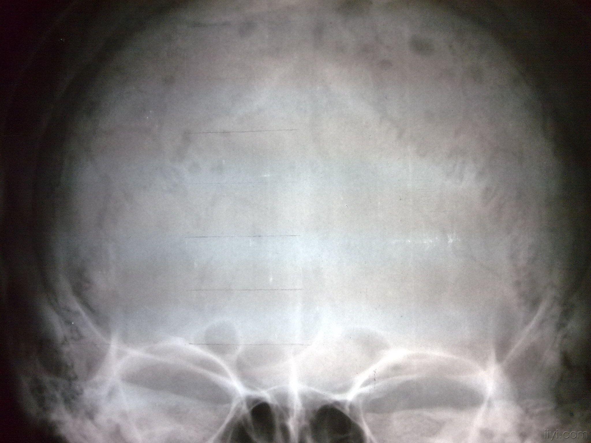 颅骨多发骨髓瘤 - 医学影像学讨论版 - 爱爱医医学论坛