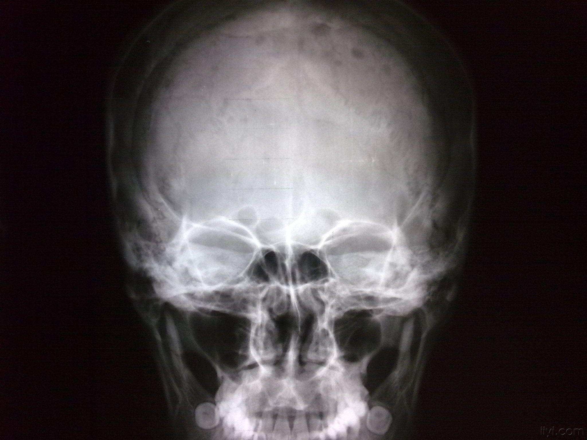 颅骨多发骨髓瘤 - 医学影像学讨论版 - 爱爱医医学论坛