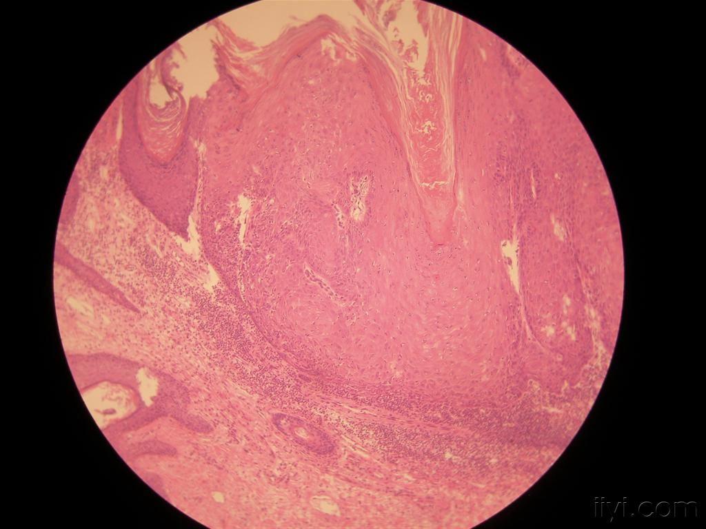 典型病例交流9 角化棘皮瘤 皮肤及性传播疾病讨论版 爱爱医医学