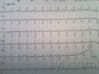 病人是肺病住院 房扑?交界性心动过速?