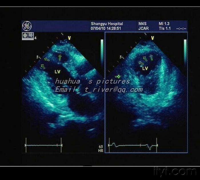 我的一客户【心梗后室壁瘤形成】 - 超声医学讨论版