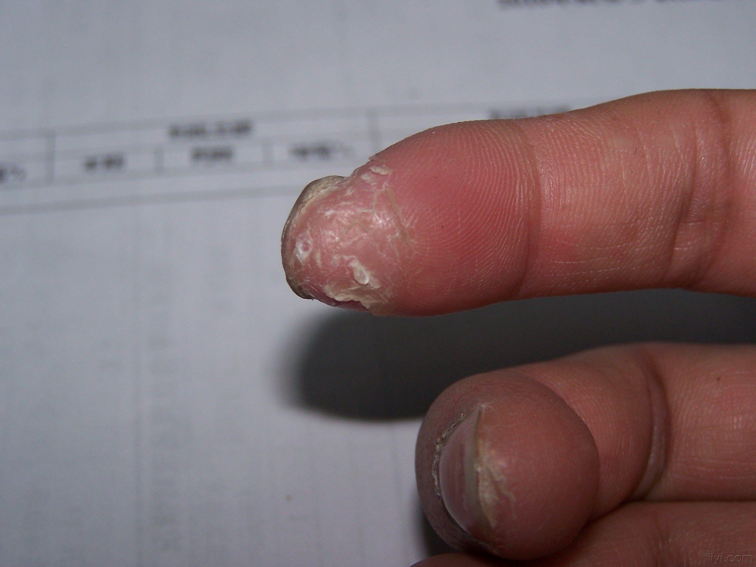 于 2010-4-13 14:29 编辑   患者男性,30岁,手指指端皮肤变硬,脱皮8余