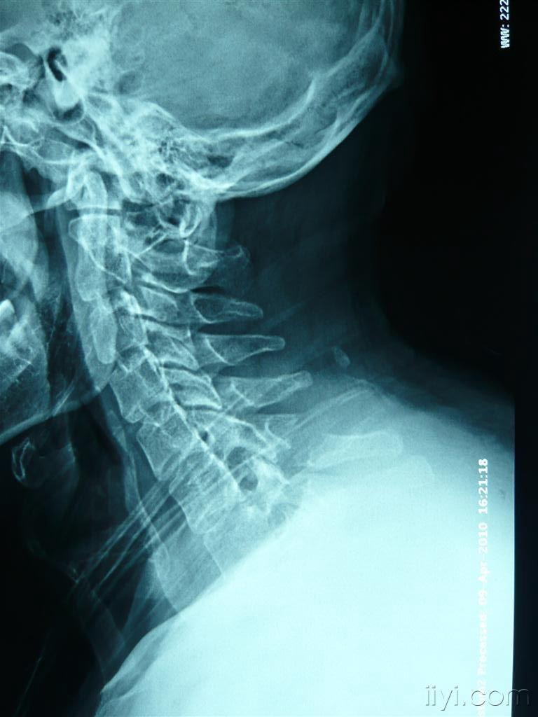 一例少见的c6椎体棘突骨折合并第一肋骨骨折