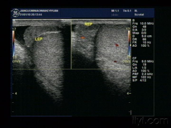附睾炎一例 - 超声医学讨论版 - 爱爱医医学论坛