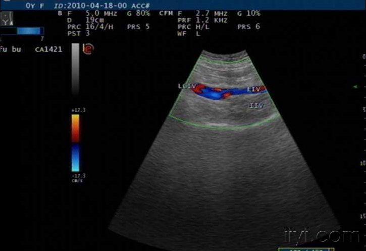 关于髂静脉 超声医学讨论版 爱爱医医学论坛