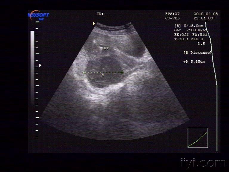 浆膜下子宫肌瘤(更新 超声医学讨论版 爱爱医医学论坛