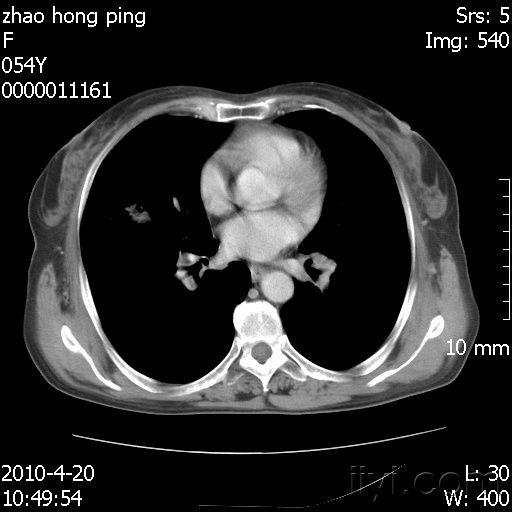胸部增强ct www.iiyi.com