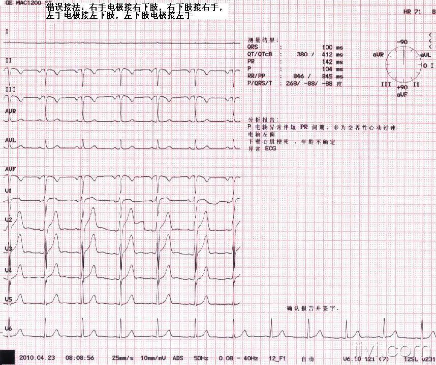 2-男67岁上下肢完全反接心电图.jpg