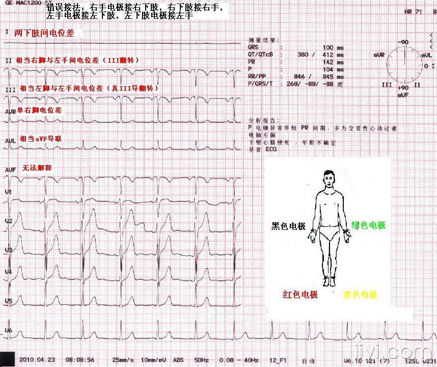 2-男67岁上下肢完全反接心电图-2解释.jpg