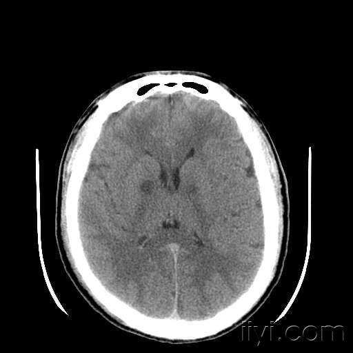 脑部ct