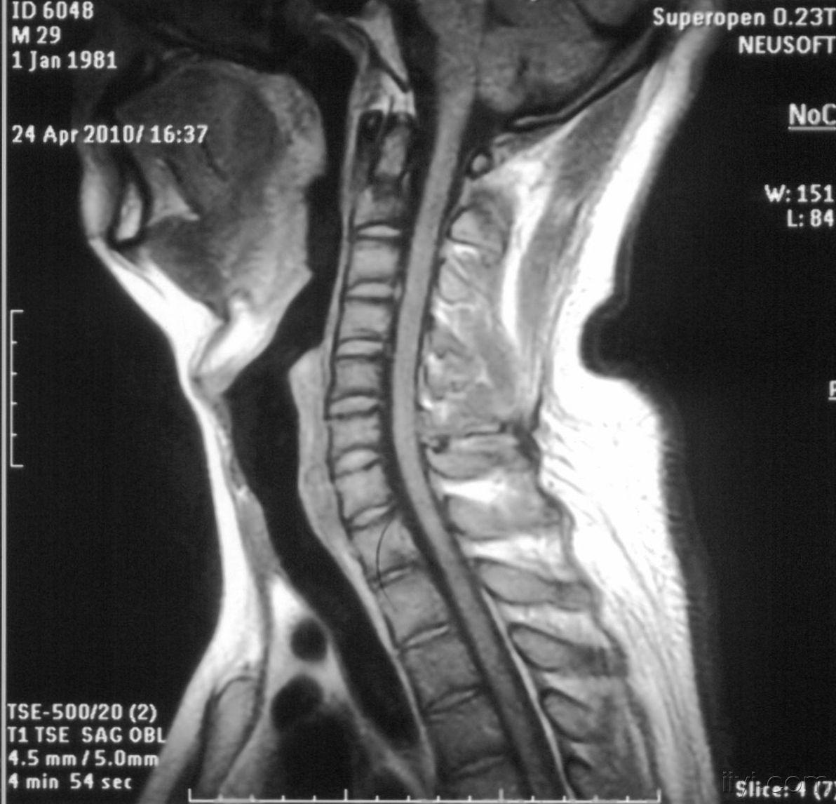 男性29岁公务员因感觉颈部不适行mr检查发现第二颈椎信号异常