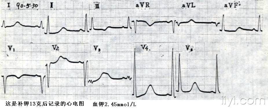 高钾患者出现不典型低钾心电图-3.jpg