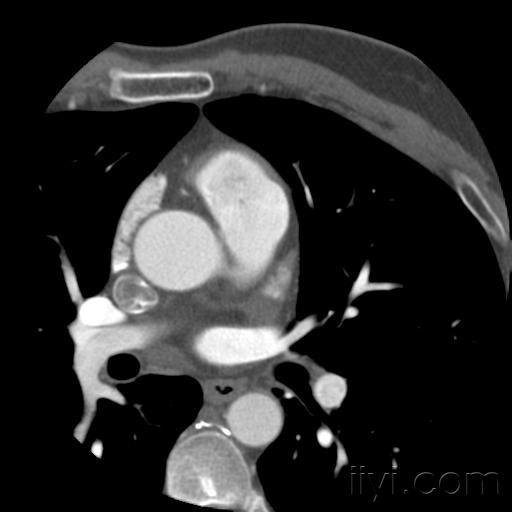 冠状动脉cta及变异大家分享