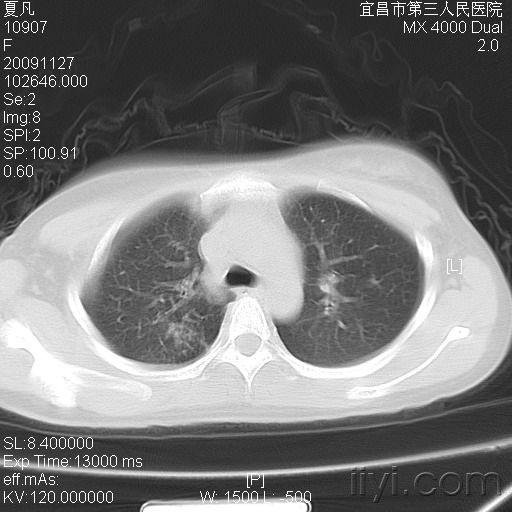 急求教以下病例怎样区分大叶性小叶性肺炎在线等谢谢