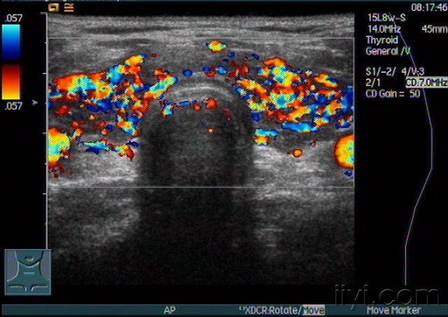甲状腺功能亢进声像图——zengerya - 超声医学讨论版