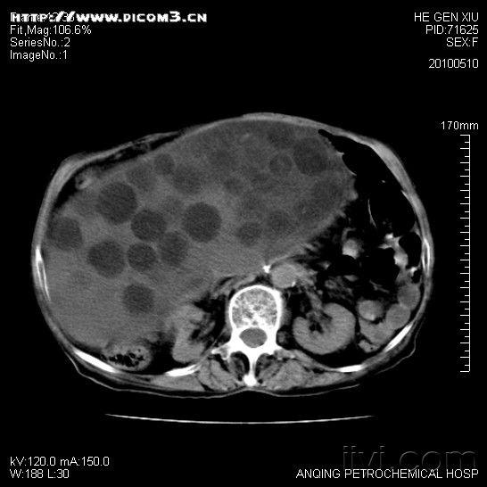 [读片]腹部病变/ct及/20100510