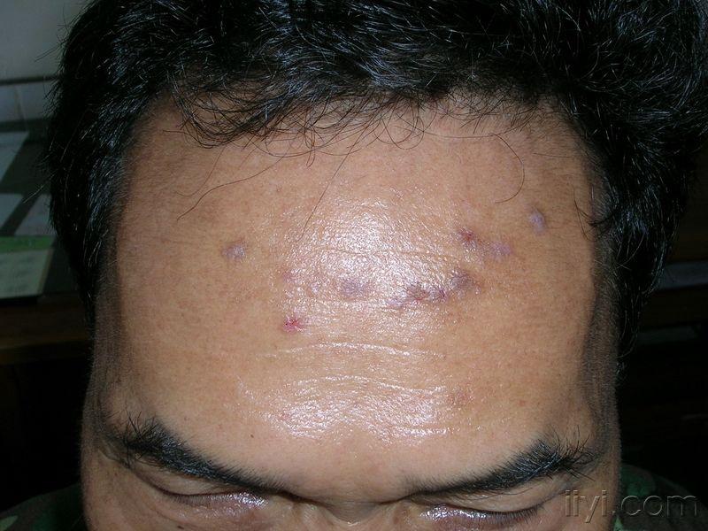此病例的诊治--神经性皮炎?真菌感染? - 皮肤及性传播