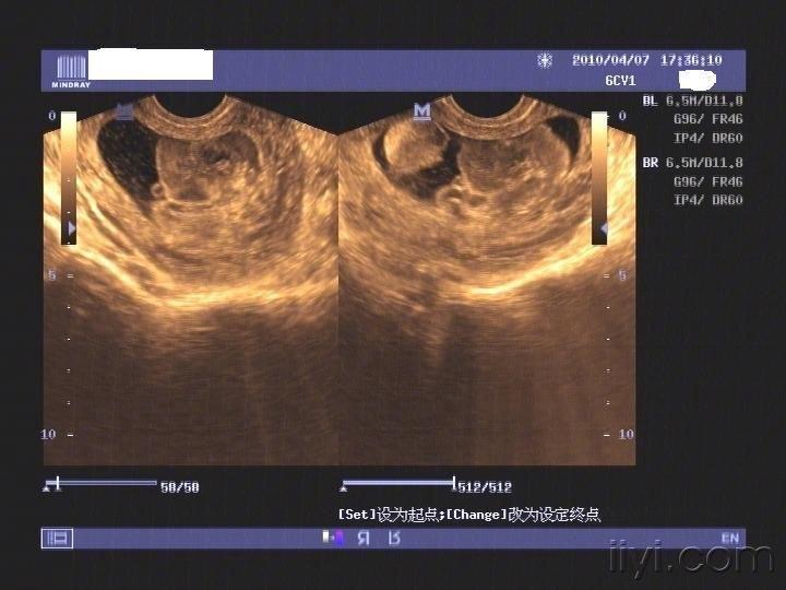 这个是葡萄胎吗? - 超声医学讨论版 - 爱爱医医学论坛