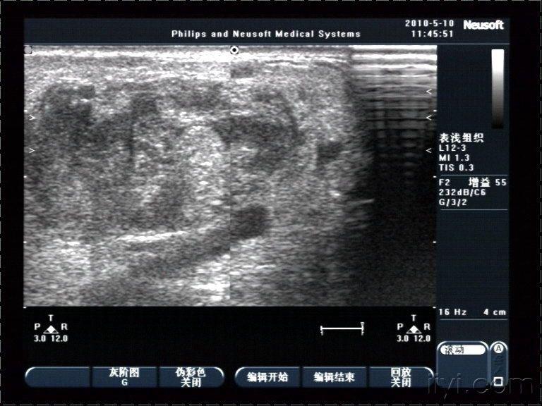 成人腮腺内实质性肿块 - 超声医学讨论版 - 爱爱医