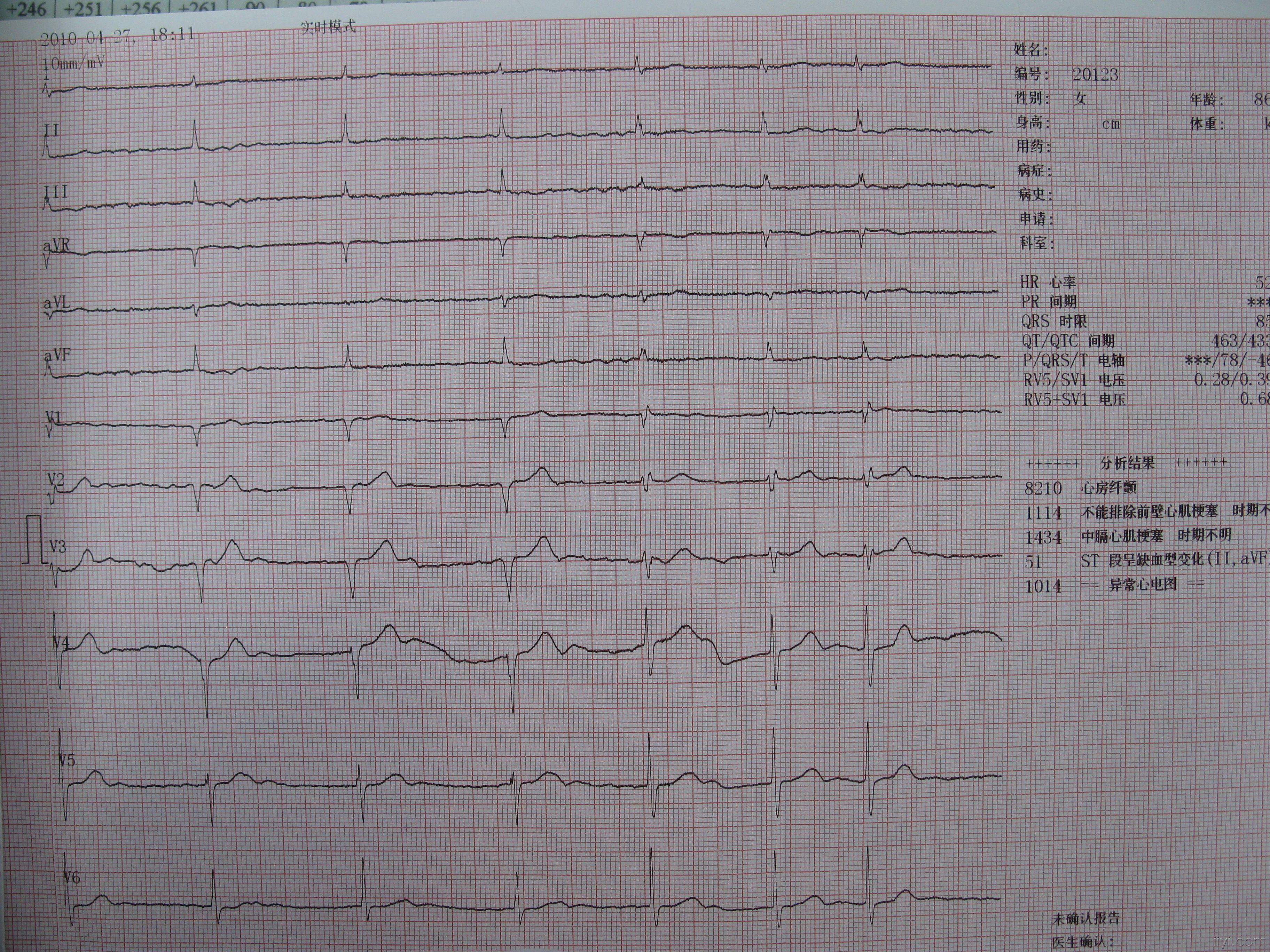 大家看看这张心电图