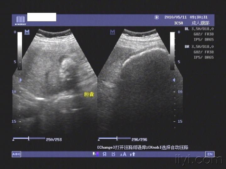 史上最大的胆囊结石! - 超声医学讨论版 - 爱爱医医学论坛