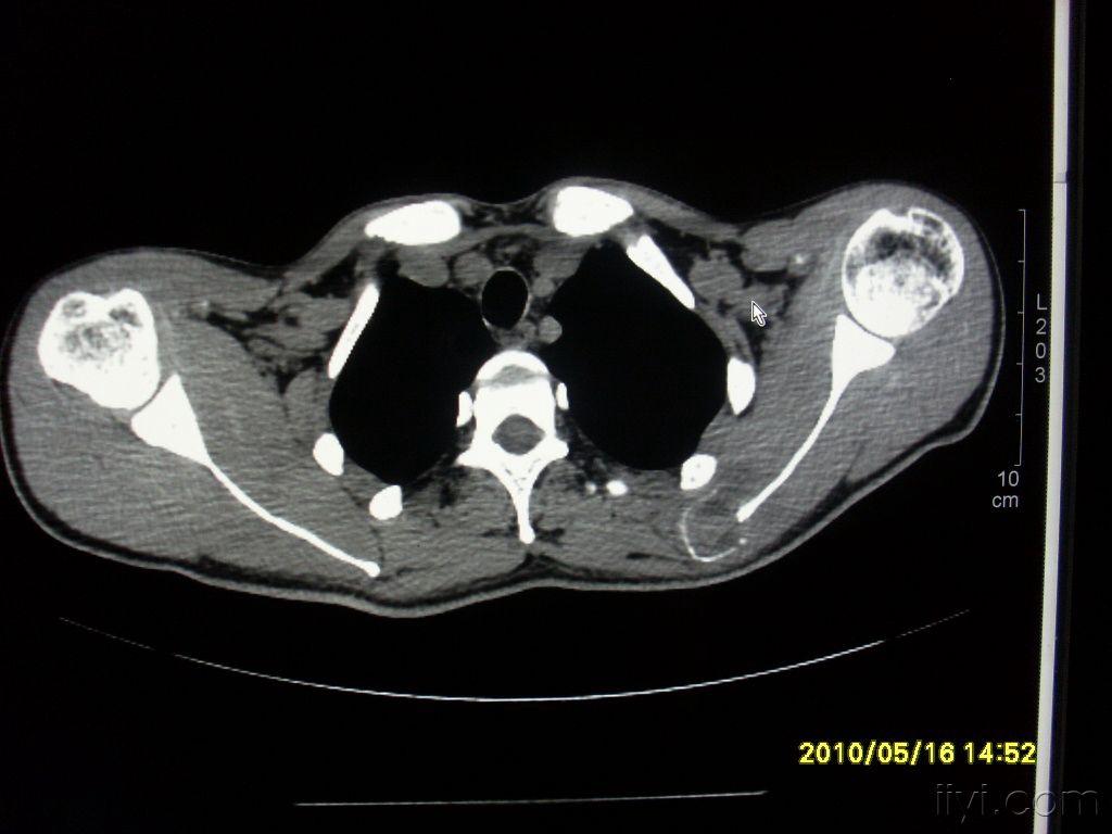 左肩胛骨病变
