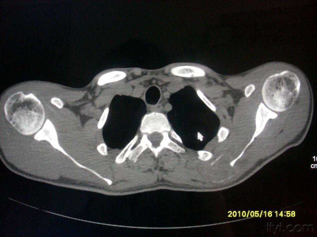左肩胛骨病变