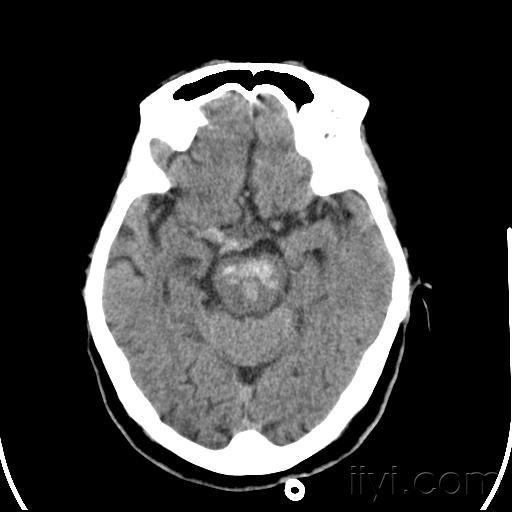 脑干出血分享