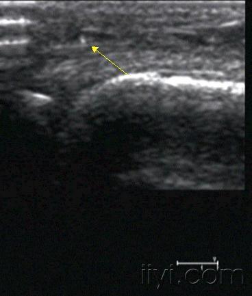 讨论:这个"包块"(临床考虑痛风性关节炎) - 超声医学