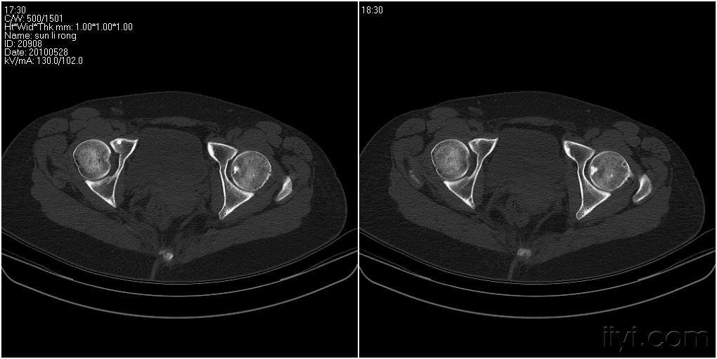 分享一例股骨头疝窝及骨岛