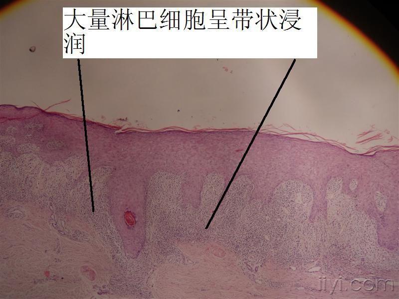 扁平苔癣