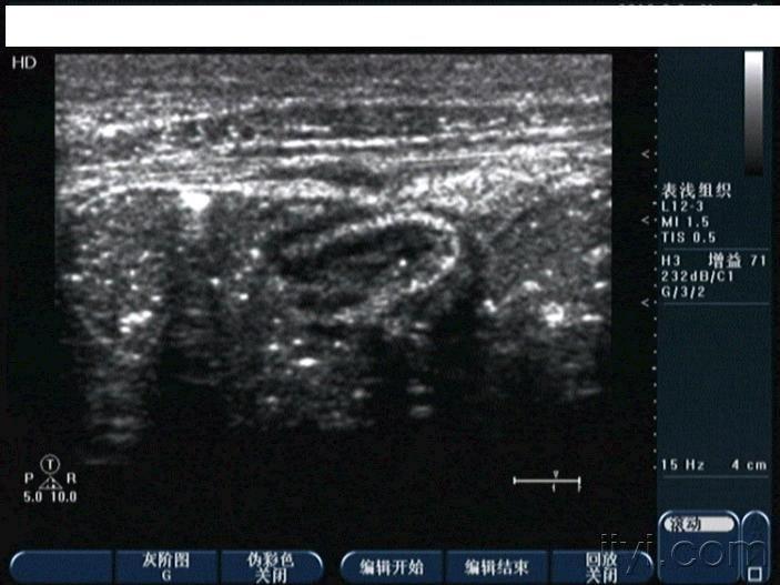 美丽的回盲部 超声医学讨论版 爱爱医医学论坛