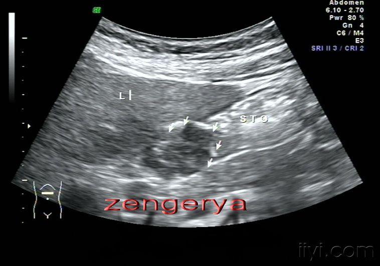 肠道肠壁增厚性病变—zengerya 超声医学讨论版 爱爱医医学论坛