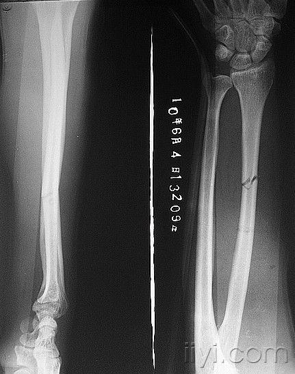 讨论:从术前片看,桡骨远端掌侧缘和尺骨茎突有无骨折?